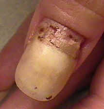 MMA Nail Damage